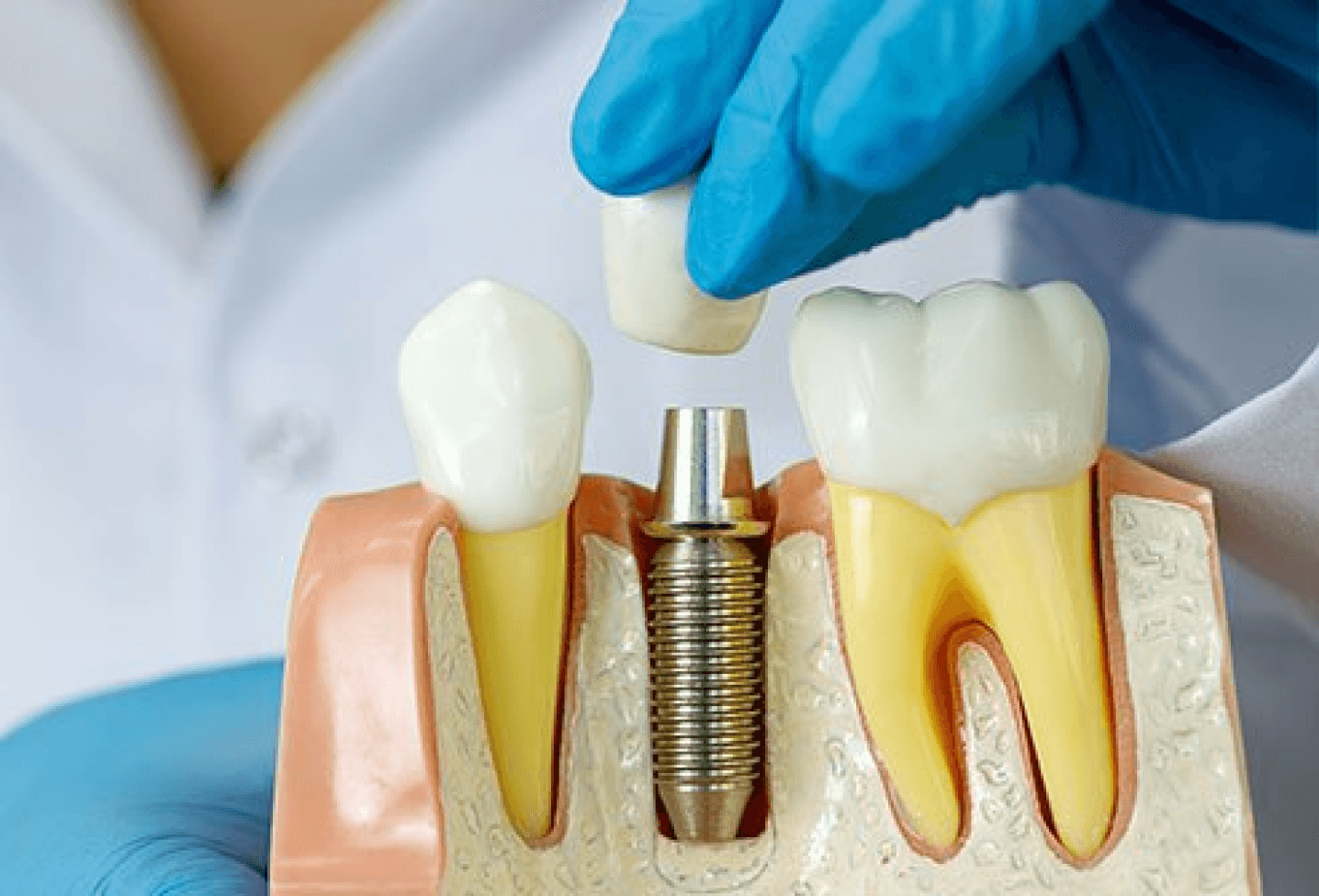 Dental Implants: The Modern Solution for Tooth Loss