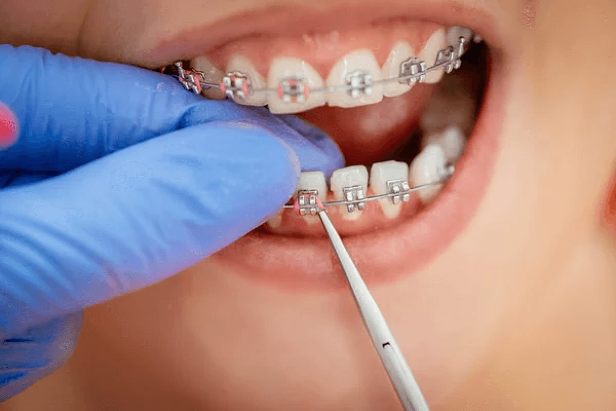 Orthodontic Treatment: Straightening Smiles for a Lifetime