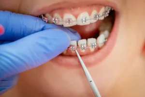Orthodontic Treatment: Straightening Smiles for a Lifetime